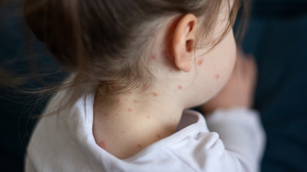 Surto de sarampo leva à quarentena de mais de 150 alunos na Carolina do Sul
